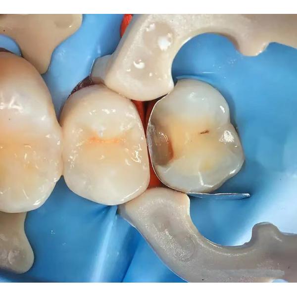 Dental Sectional Matrix System F2 Autoclavable includes Sectional Matrix Bands M2 + Resin Clamping Ring R3