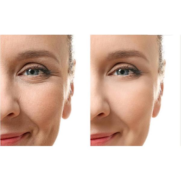 заполнитель 1ml 2ml 5ml Skinject Hyaluronic кисловочный лицевой