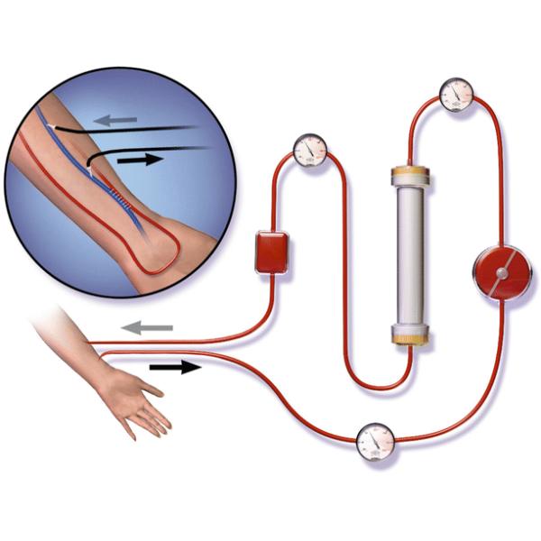 200-микронный трубчатый фильтр из ПП с нейлоновой сеткой для капельных камер гемодиализа крови