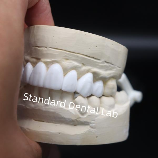 Зубные короны диагностический вакс-up высокая эстетика из китайской стоматологической лаборатории