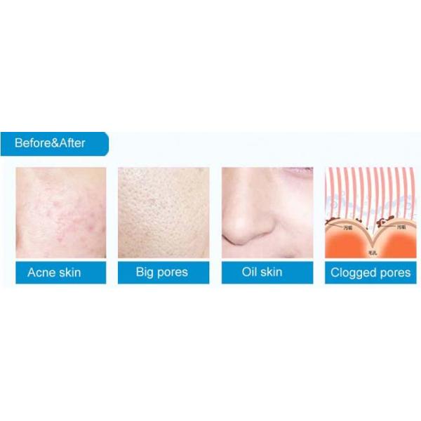 Enlèvement mort d'acné de peau de machine portative de peau de diamant de peau avec la puissance 65W