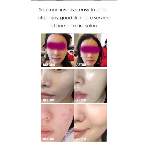 Shr Intense Pulsed Laser Hair Removal Machine 2000W Anti Puffiness