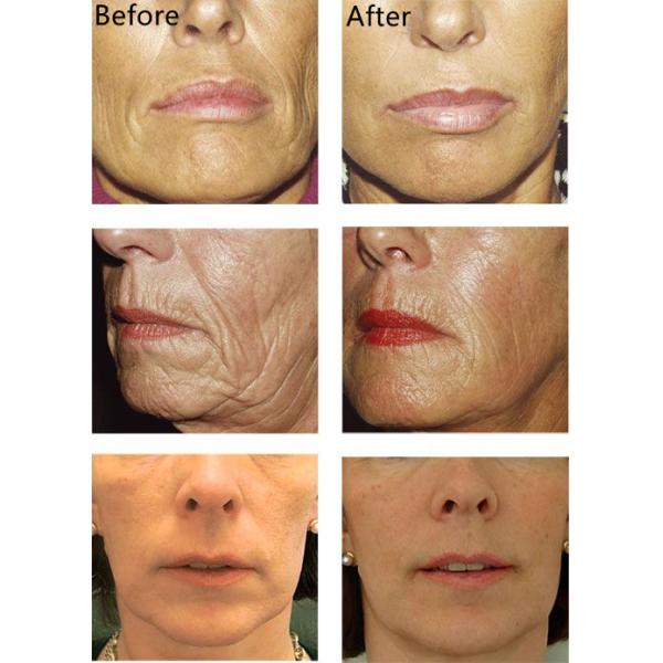 PLLA Инъекция для лифтинга лица 150 мг/ мл