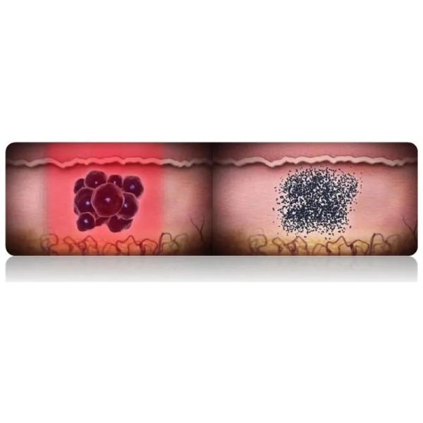 532nm 755nm 1064nm Vertical Q Switch Picosecond Laser para la eliminación del acné