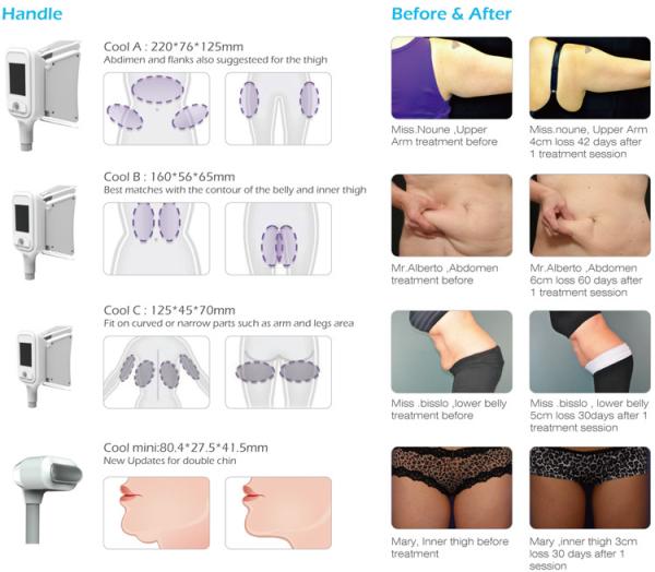 2018 New CE Approve Body Shape Freeze Fat Cooling 4 Handle Liposuction Cryolipolysis Machine