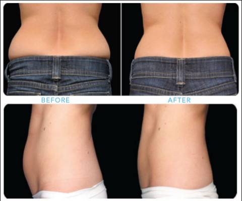 Weight Loss Cryolipolysis Body Slimming Machine , Fat Burning Equipment Non - Surgical Liposuction