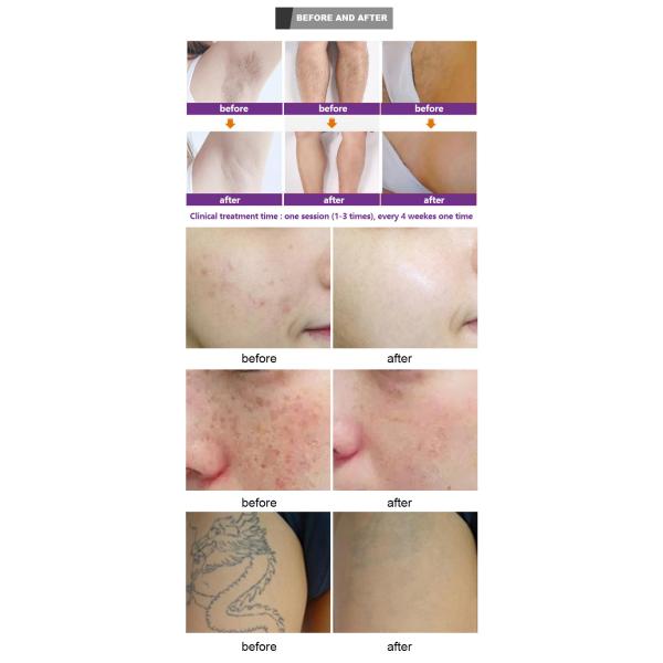 810 Pigment Removal Machine , Portable 2 In 1 IPL Beauty Laser Tattoo Removal Machine