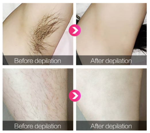 1200 nm Skin Rejuvenation IPL Hair Removal Device 120J/CM2 Energy