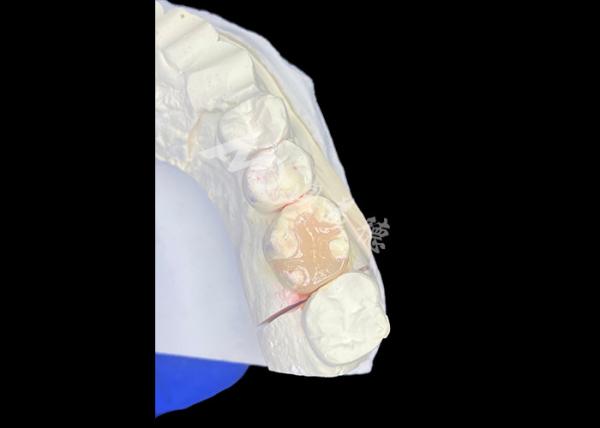 Durabilidade duradoura e ajuste preciso e colocação com inserções IPS e.max