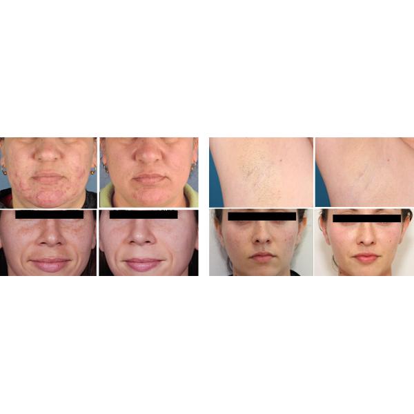 SHR Painless Hair Removal Machine , Permanent Hair Removal Laser Machine Non Invasive