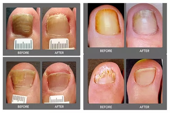 Лазер диода 980nm класса IV для терапии Onychomycosis