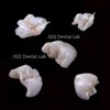 Digital Empress Onlay And Inlay Customized By Dental Prosthesis Laboratory