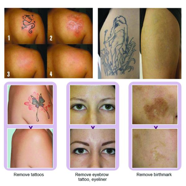 Painless ND YAG Laser Tattoo Removal Machine , Carbon Peel Probes Laser YAG Machine