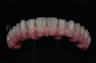 Long Lasting Titanium / Zirconia All On 4 All On 6 Rapid Recovery 1-2 Weeks