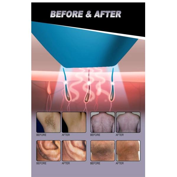 Ледяная скорость L 3 длина волны OEM коммерческая 808 диодная лазерная эпиляторная машина