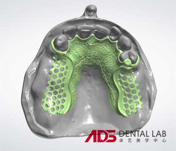 ADS Dental Lab Partial Metal Frame Denture Framework Fabrication