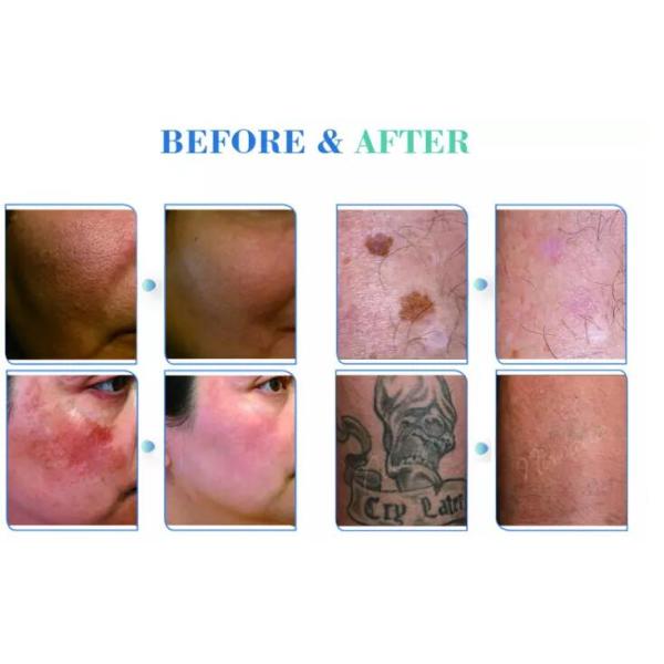 755nm Picosecond Yag Laser Tattoo Removal Machine Portable With Touch Screen