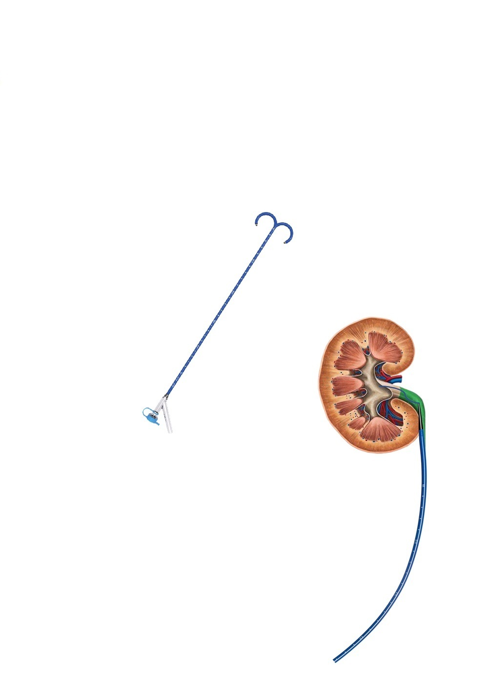 Ureteral Access Sheath