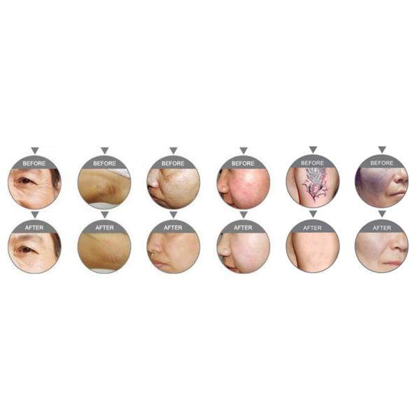 CE машины красотки подниматься стороны Ipl подмолаживания кожи удаления волос медицинский