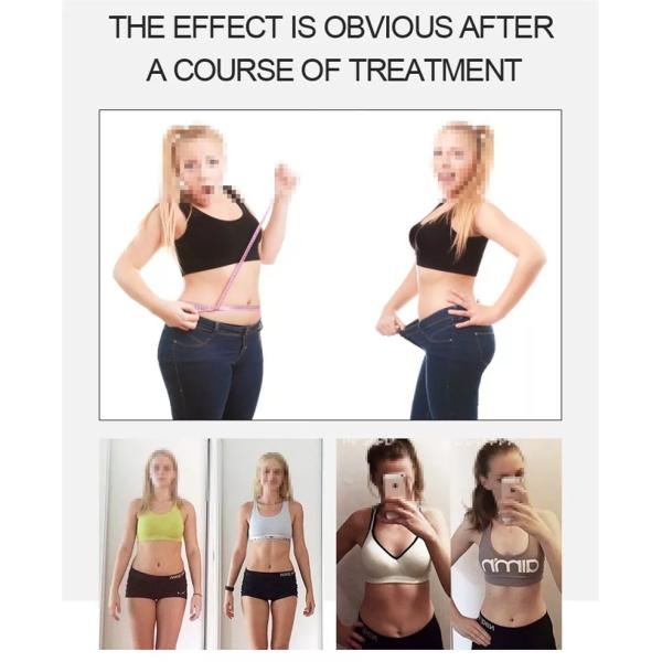 удаление целлюлита потери веса машины лазера Lipo зеленого света 532nm