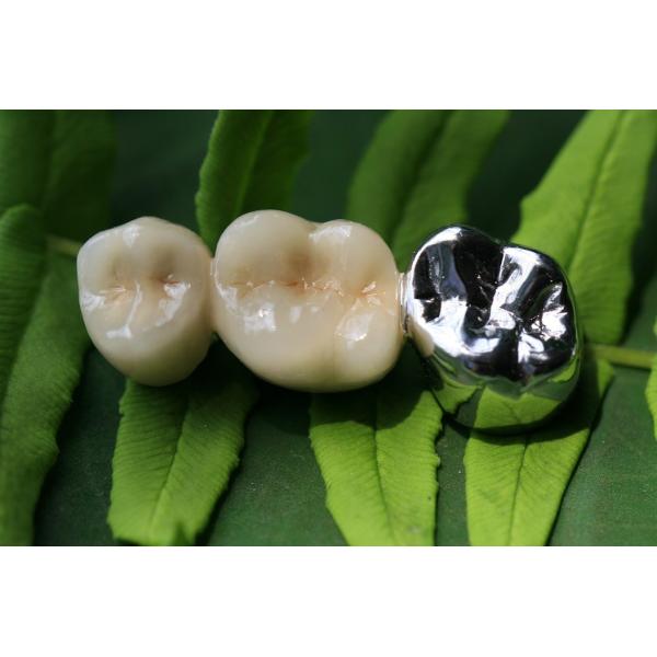 3D Print Framework PFM Dental Lab Crown For Dentistry