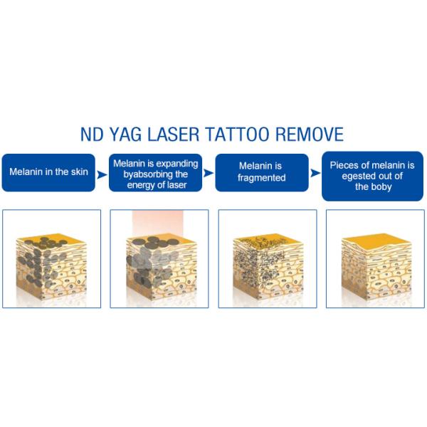 ODM лазера Nd Yag Rf выбирает удаление волос машины Shr Ipl профессиональное безболезненное