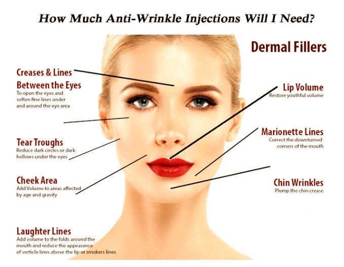 Juvederm Voluma 	Вводимый дермальный заполнитель пластиковый Chin обнюхивает ровные морщинки