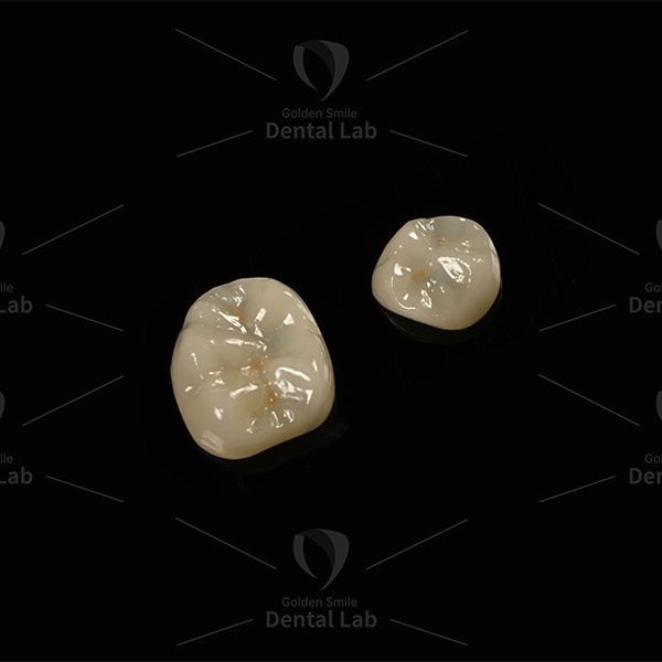 Lithium Disilicate Ceramic Full E.Max Onlay Emax Restorations High Pressure Resistance