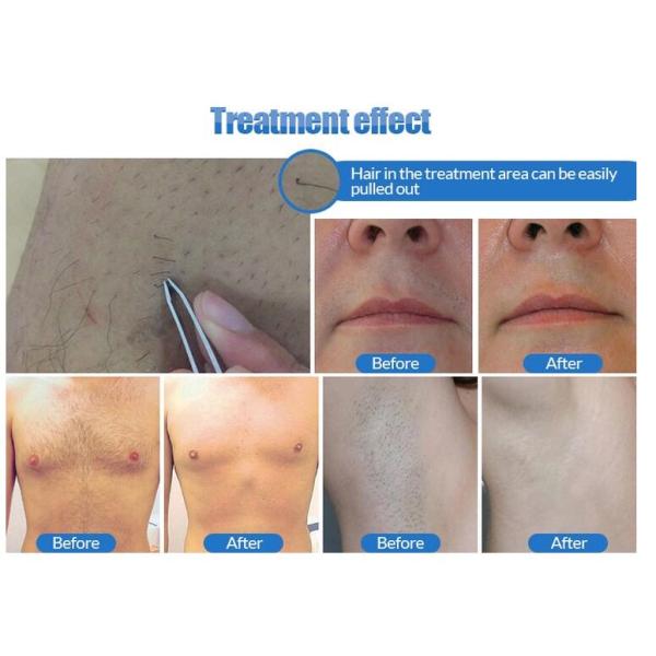 755 808 1064nm laser diode laser hair removal machine with Big spt size 23x23mm