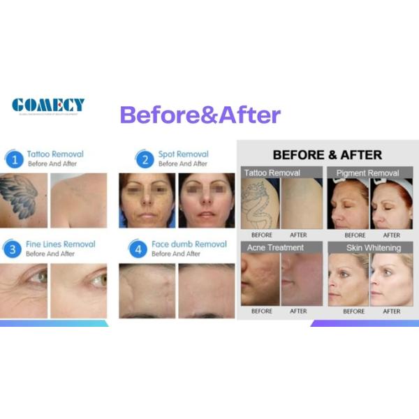 Máquina de picosegundos láser para tatuajes con pantalla táctil LCD, refrigeración y estiramiento de la piel