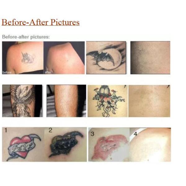 Multifunctional Tattoo Laser Removal Equipment With 1064 nm 532 nm Black Ball Tip