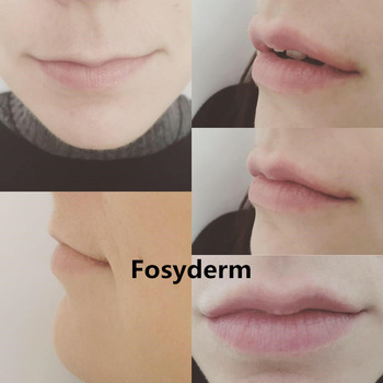 1ml 2ml 10ml Injectable Dermal Filler , Cross Linked Hyaluronic Dermal Fillers Ha