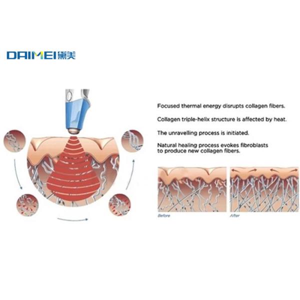 Ultrasound Cavitation Weight Loss Machine HIFU BTL Facial Skin Firm Tightening