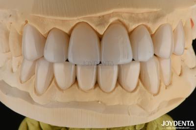0.3-0.5mm Thick Feldspathic Porcelain Veneer High Fracture Resistance Upgrade Your Smile