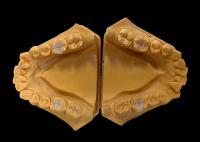 Inlays en céramique biocompatibles Onlays de restauration dentaire sans couture avec résistance aux taches