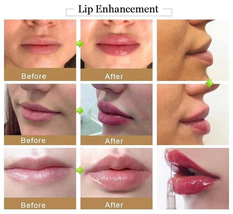 Заполнитель Allergan Juvederm дермальный для заполняя морщинок и линий доступное онлайн и В-магазина