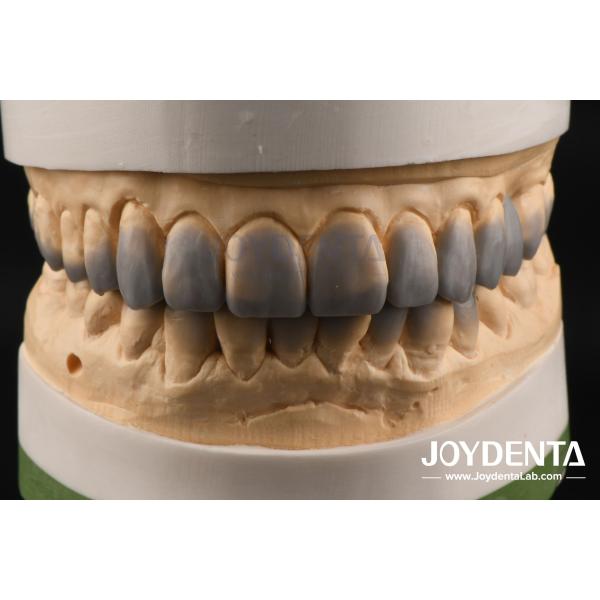 Natural Color Dental Wax Up Versatile Solution for Single or Multiple Teeth