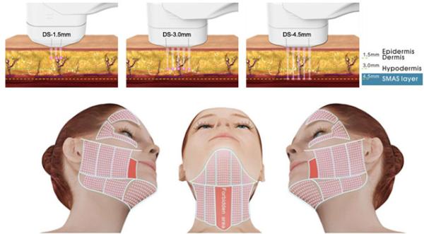 Skin Tightening HIFU Beauty Machine High Intensity Ultrasound Therapy For Beauty