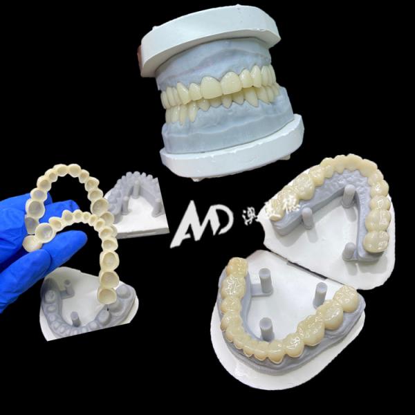 PMMA Provisional Implant Bridge with Hollow Inside for Stability and Natural Healing, High-precision CAD/CAM Fabrication, Biocompatible PMMA Material