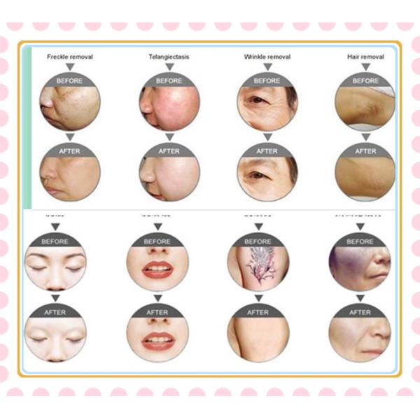 High quality shr ipl hair removal / ipl shr hair removal machine(CE, ISO,TUV)