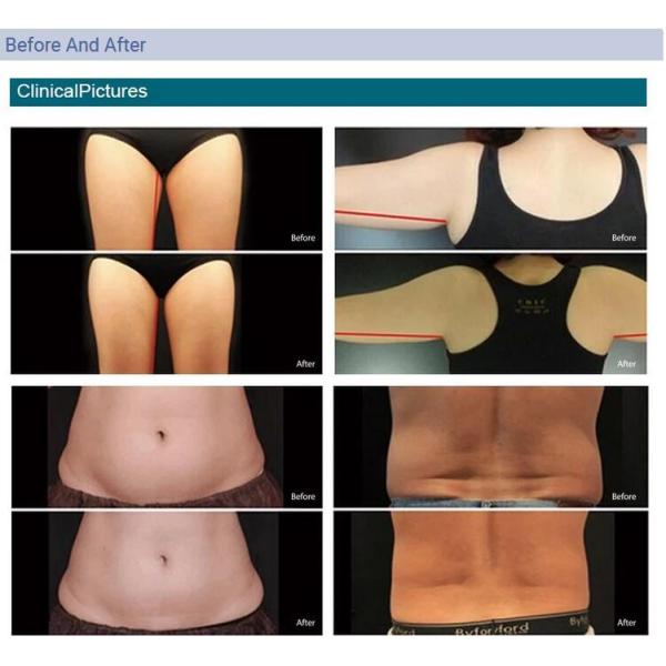 Effective Cryolipolysis Slimming Machine , 4 - Handle Body Fat Freezing Machine