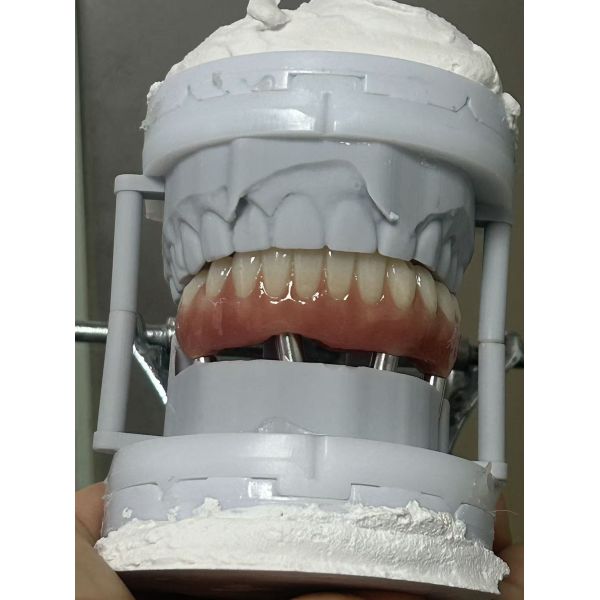 Monolithic Zirconia Implant Bridge for Full Arch Restoration with CAD/CAM Precision