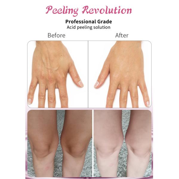 Peeling Solution Skin Exfoliating Oil High Quality 45% Skin Peeling Solution