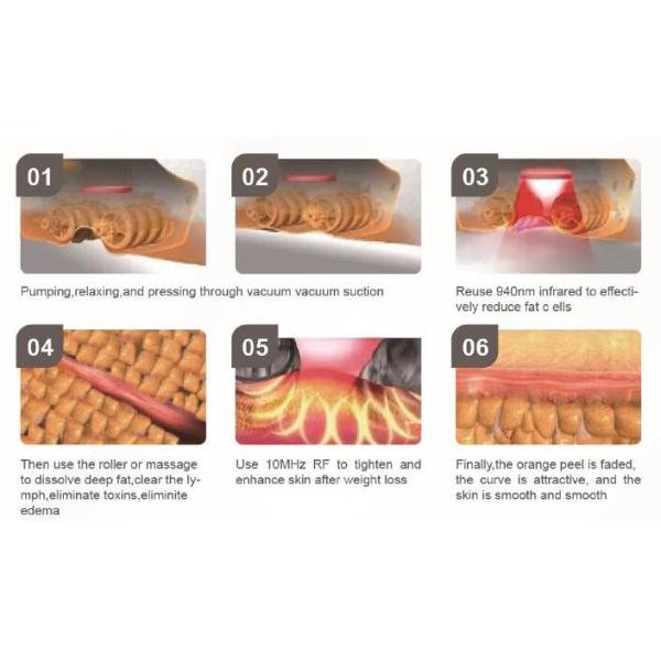 Radio Frequency Vacuum Suction 940nm Skin Tightening Machine