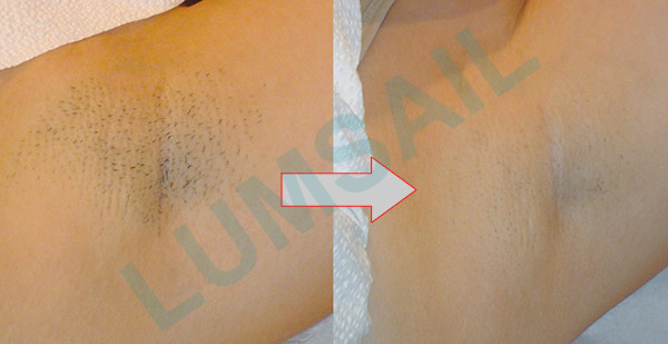 SHR System IPL Permanent Hair Removal Machine For Unwanted Hair Removal