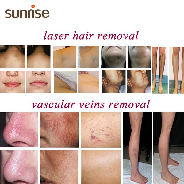 The Best Painless Hair remover Yag Long Pulse Laser Hair Removal Machine