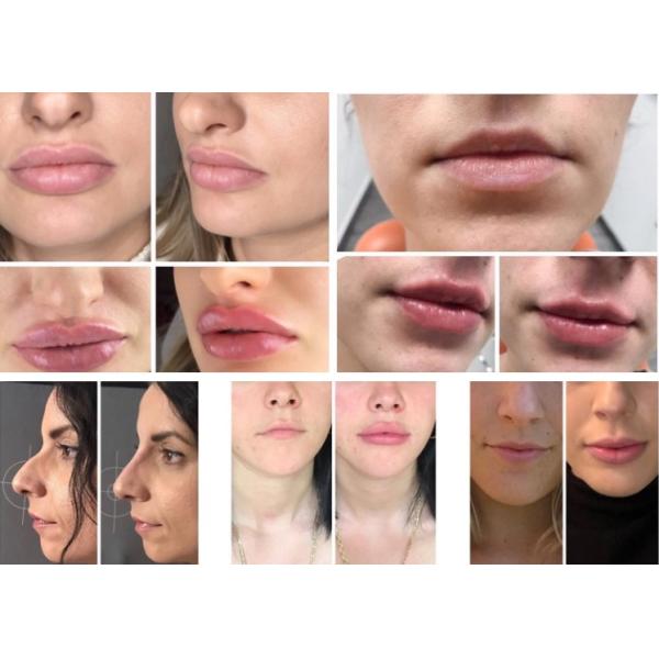 Revolax Hyaluronic Acid Face Filler For Youthful Skin Rejuvenation