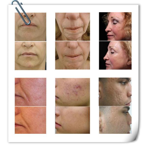 CE approved factory supply frational rf wrinkle removal fractional microneedle radiofrequency acne scars removal