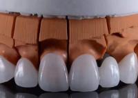 FDA aprovado coroas dentárias de zircônio translúcidas