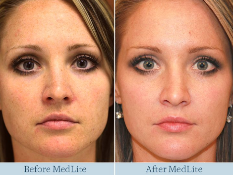 RF Co2 Fractional Laser  Tightening Rejuvenation Skin Peeling Beauty Machine